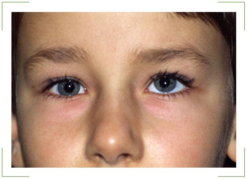 Один глаз видит хуже другого: причины, профилактика, лечение - "здоровое око"