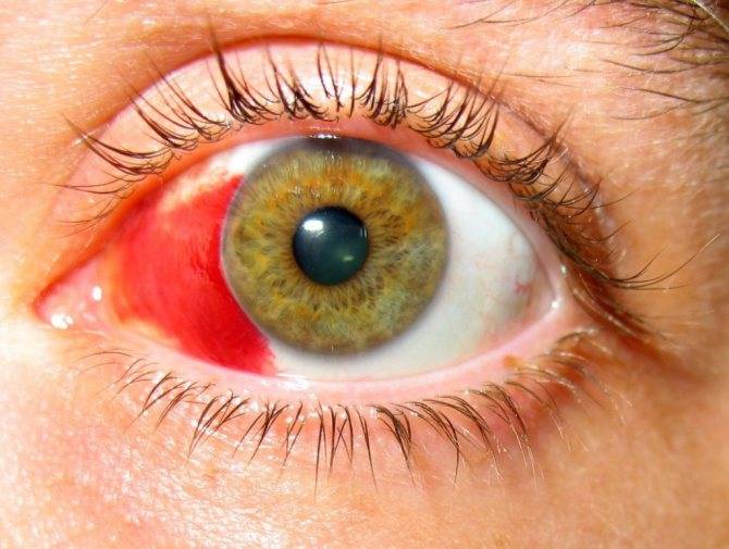 Гемофтальм глаза - что это, причины и лечение