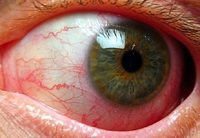 Ангиопатия сетчатки глаза у ребенка - что это такое