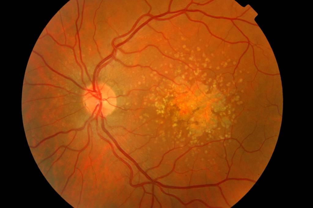 Пхрд сетчатки – ретинальные дегенерации обоих глаз при периферической витреохориоретинальной дистрофии