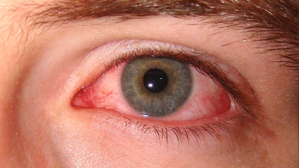 Грибок глаз: фото, как выглядит грибковое поражение век, роговицы, конъюнктивы, слезных путей, симптомы и лечение заболевания внутри глаза, глазные капли
