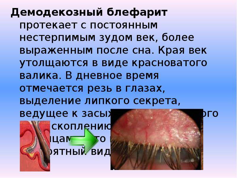 Блефарит: симптомы и лечение. виды блефарита
