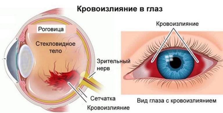 Что делать, если лопнул сосуд в глазу: виды кровоизлияний и лечение