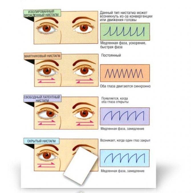 Что такое нистагм глаз у взрослых и детей: симптомы и лечение