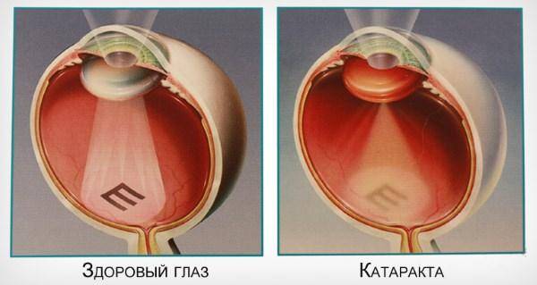 Зрелая катаракта: нужна ли операция при незрелой, код по мкб-10, лечение недоразвитой, перезрелой и запущенной стадий