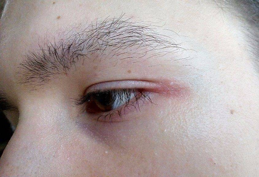 Чешутся уголки глаз: причины и методы лечения - "здоровое око"