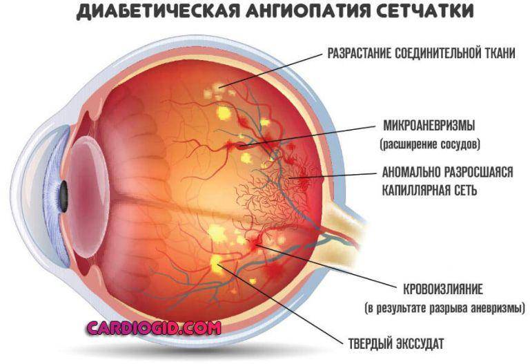 Ангиопатия сосудов сетчатки обоих глаз (ои) у ребенка: причины и лечение
