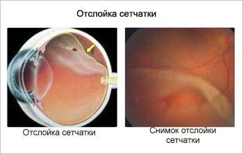 Виды отслойки сетчатки глаза, причины и методы лечения