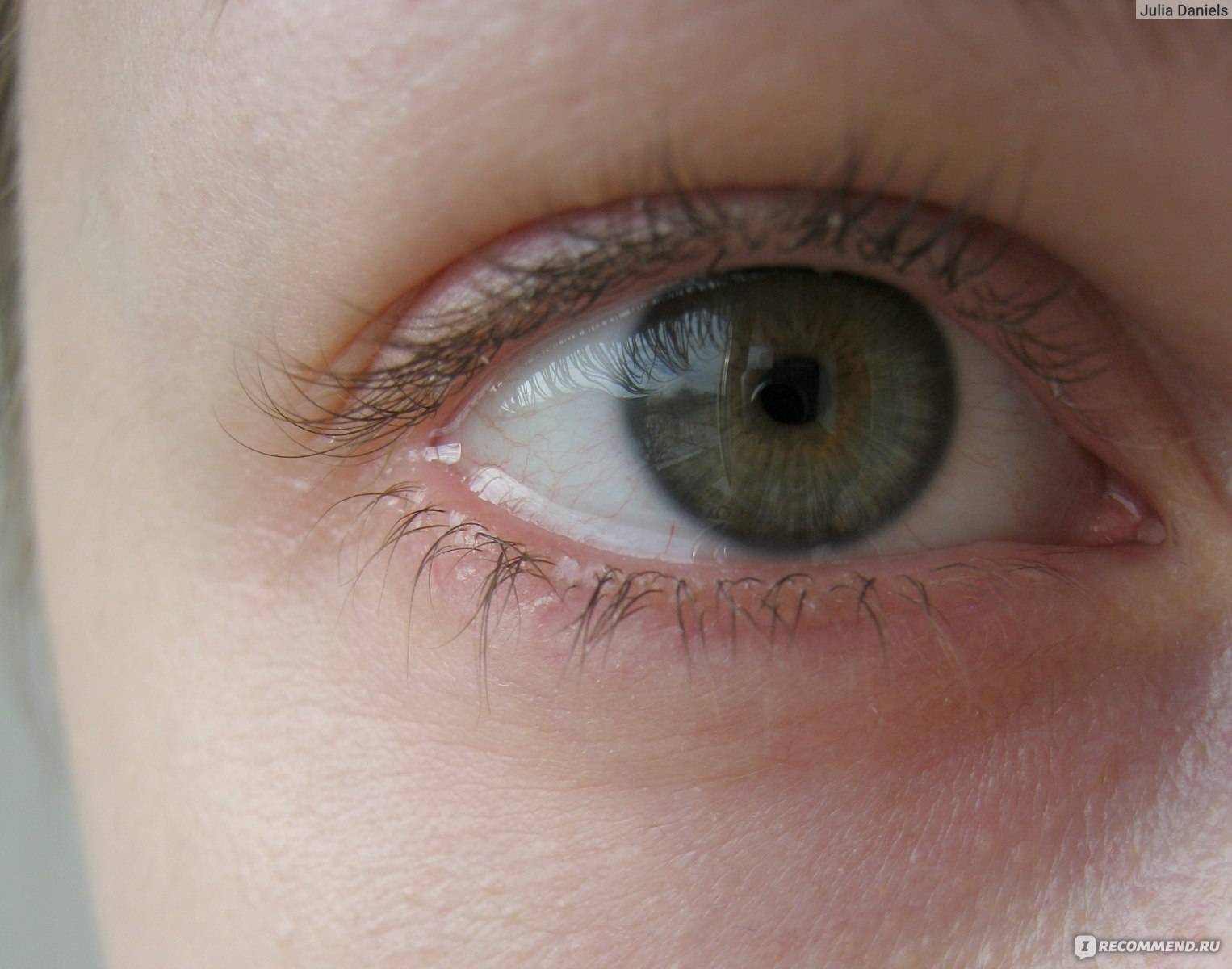 Синдром сухого глаза: 7 причин и способы лечения