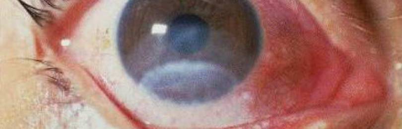 Тупые травмы глаза: описание патологического состояния, его симптоматика и терапия