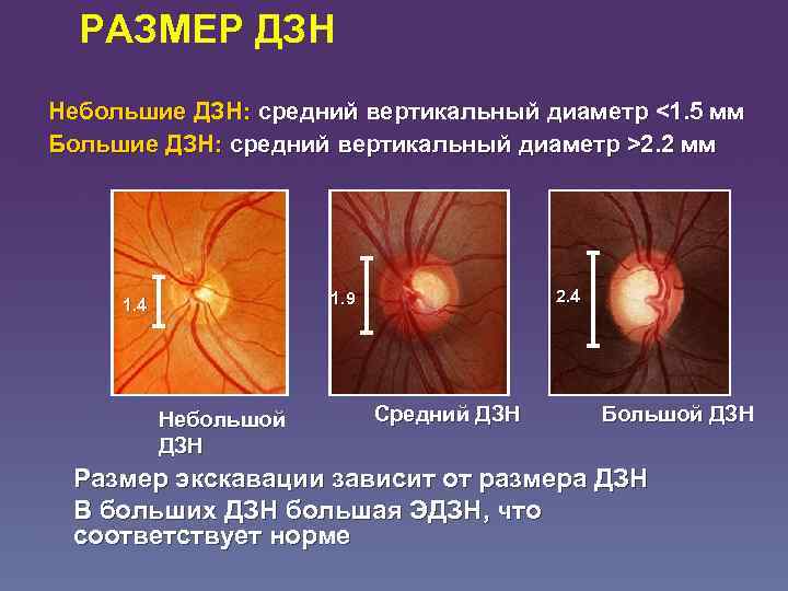 Последствия глаукомы: атрофия зрительного нерва, трубчатое зрение
