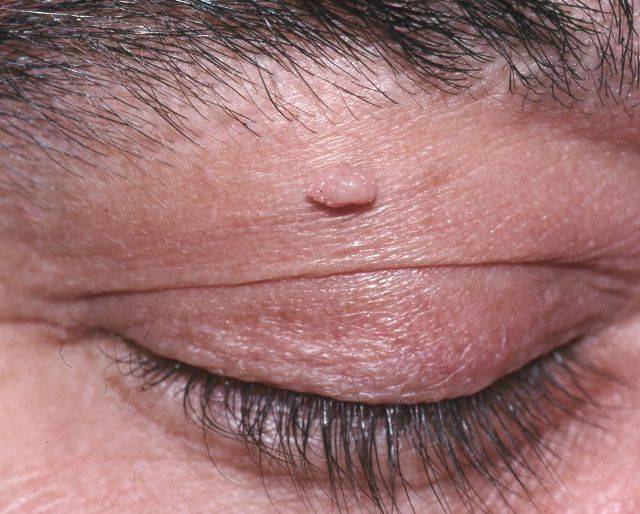 Атеромы на лице и голове: лечение, особенности и фото