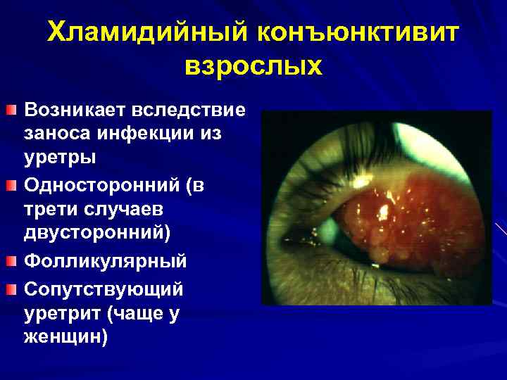 Хламидийный конъюнктивит (хламидиоз глаз): симптомы, лечение и прочие аспекты