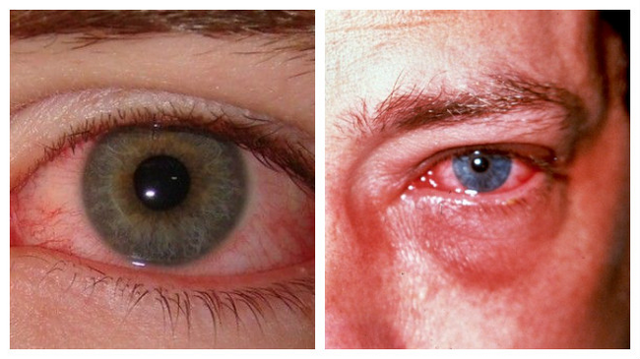 Причины, симптомы и лечение эрозии роговицы глаза.
