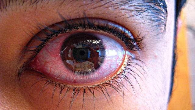 Склерит (воспаление склеры глаза): причины, симптомы, лечение (капли, народные средства и другое) и прочие аспекты