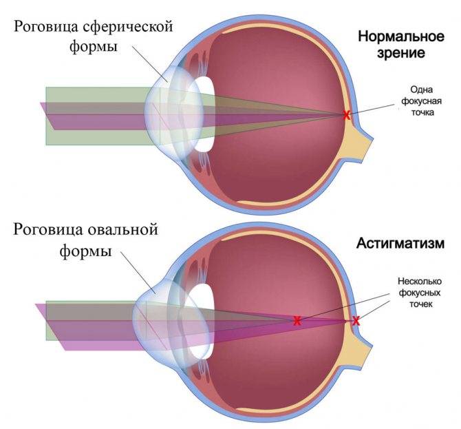 Заболевание органов зрения – миопический астигматизм