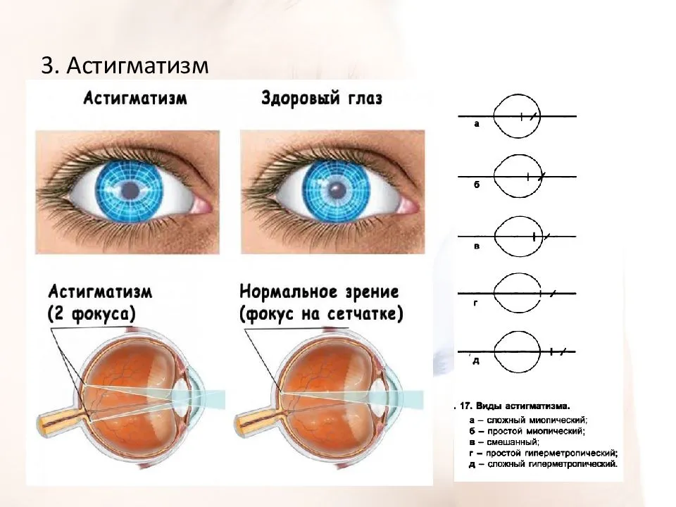 Линзы при астигматизме: особенности и правила подбора — глаза эксперт