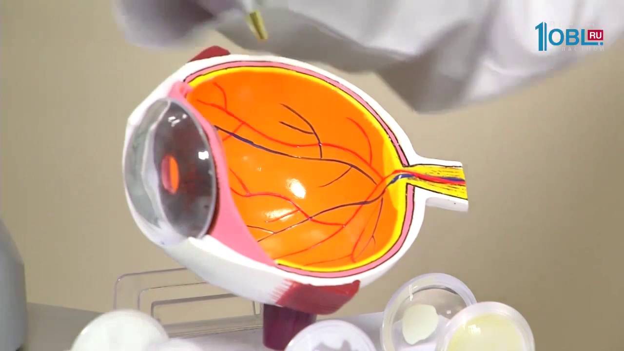 Витреолизис - лазерное удаление мушек в глазах, отзывы, последствия, цена