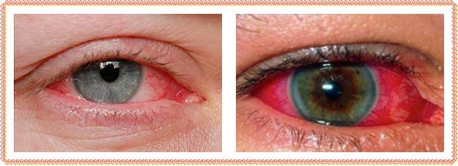 Кровоподтек в глазу: причины и лечение. сколько проходит кровоподтек в глазу