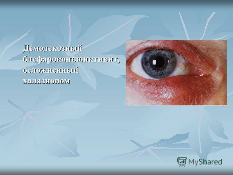 Блефарит: симптомы и лечение у взрослых, причины воспаления, что это такое (фото)