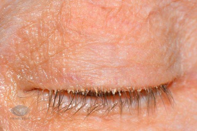 Хронический блефарит: симптомы и лечение обоих глаз