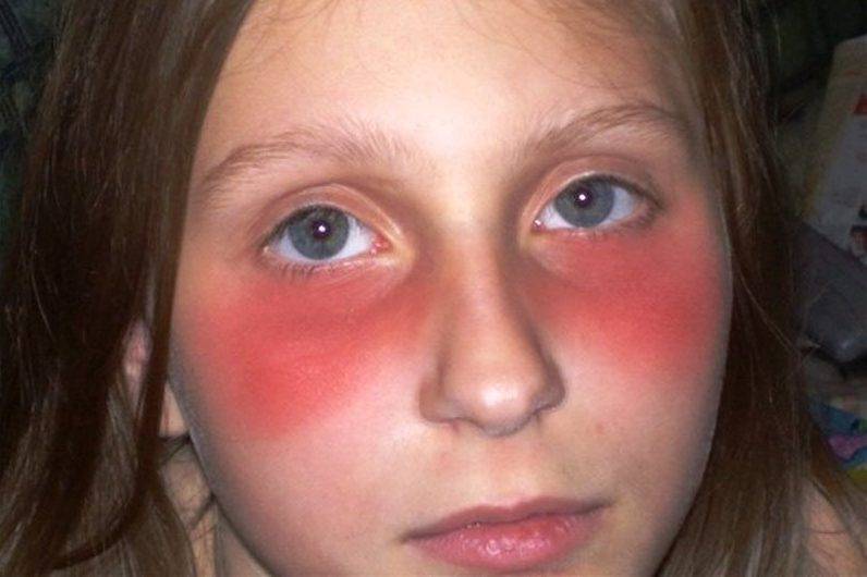 Красные пятна под глазами у ребенка: причины их появления, точек, прыщиков и различного рода сыпи на веках