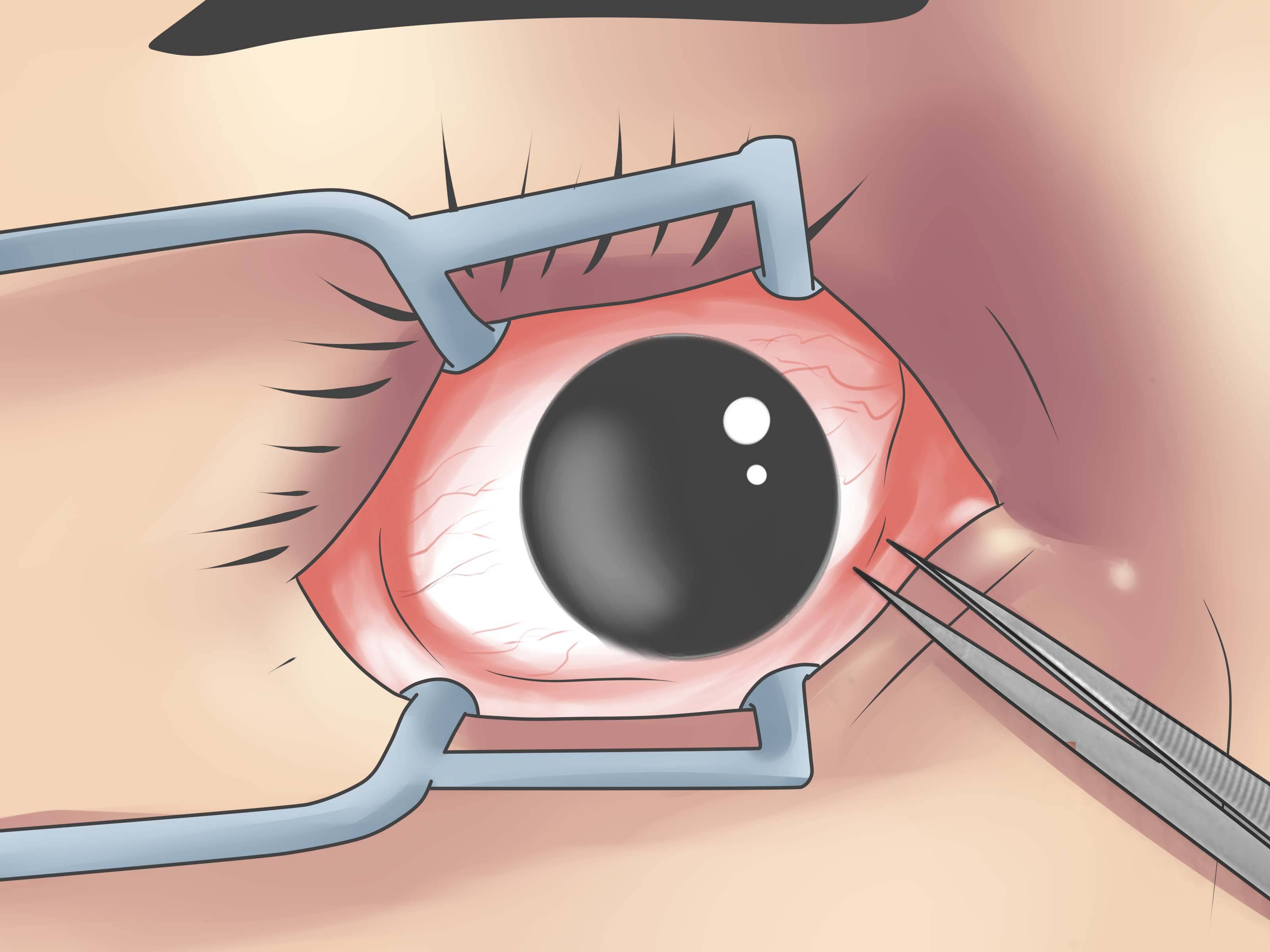 Киста глаза: симптомы и лечение - "здоровое око"