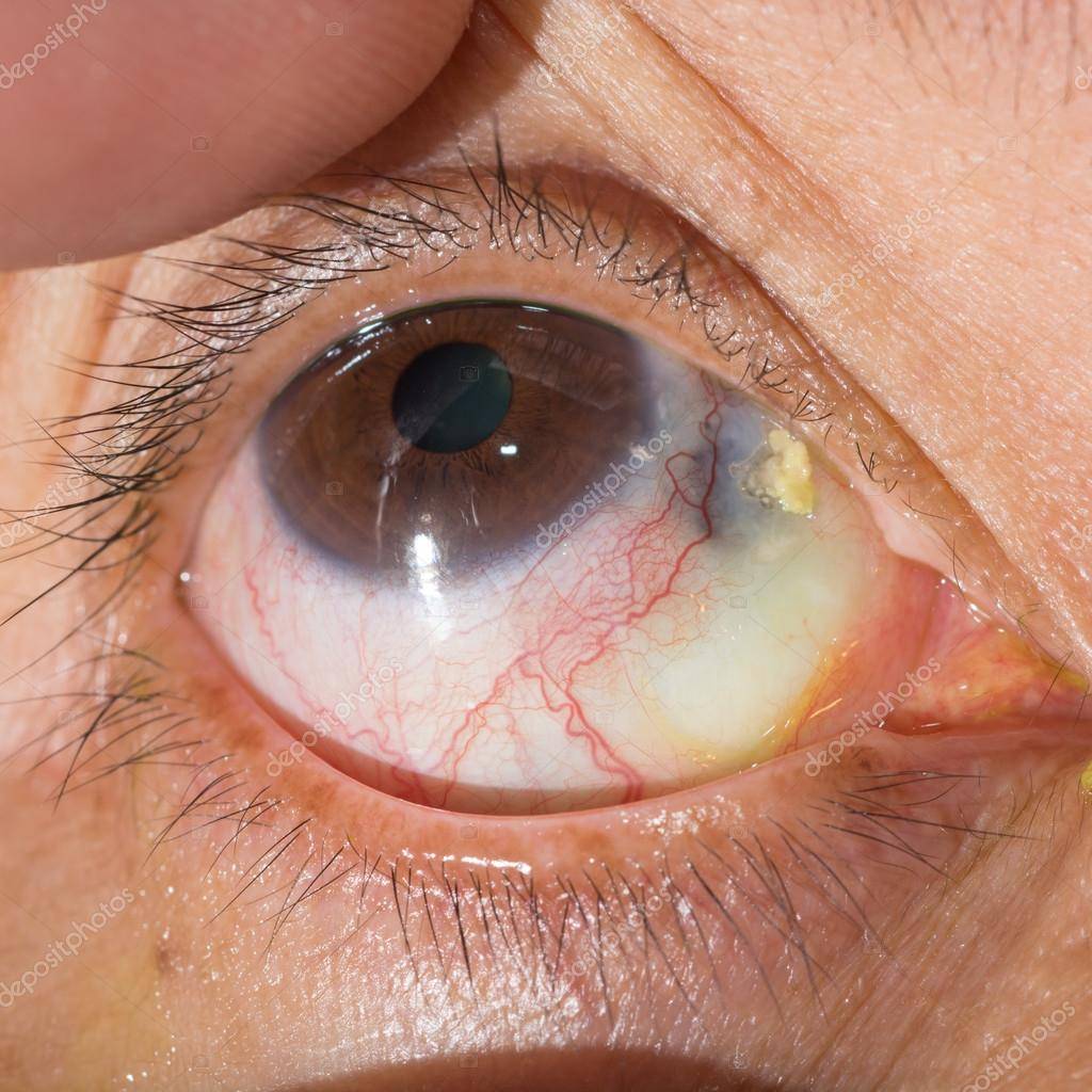 Причины развития птеригиума и операция по удалению нароста на глазу