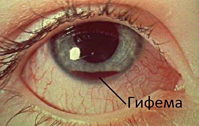 Гифема: что нужно знать о кровоизлиянии в глаз
