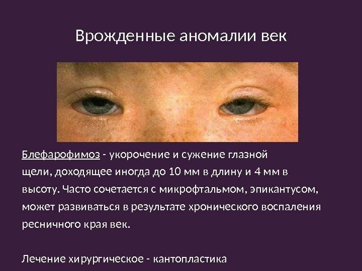 Ретинобластома глаза: симптомы, стадии, лечение, причины и осложнения
