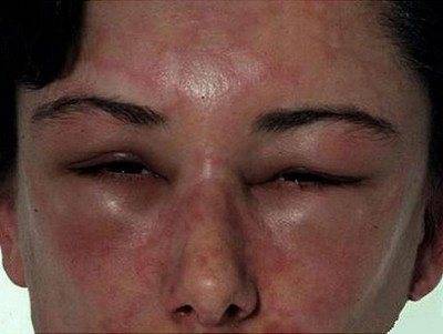 Почему может отекать лицо при аллергии и как снять отек?