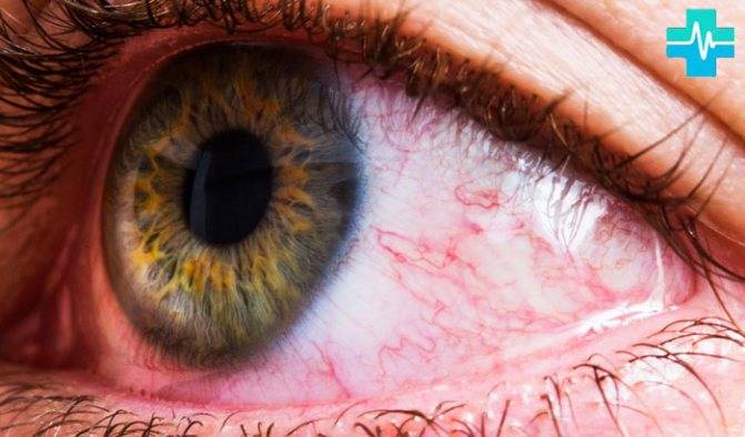 Лопнул сосуд в глазу: капли, которые помогут избавится от симптома, какие средства помогут в домашних условиях, что делать при травме глаза