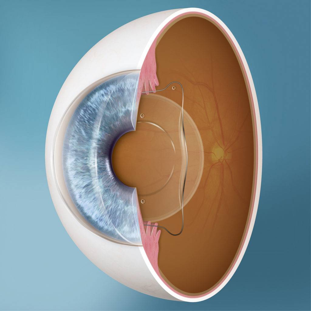 Имплантация факичных интраокулярных линз в клинике микрохирургии глаза