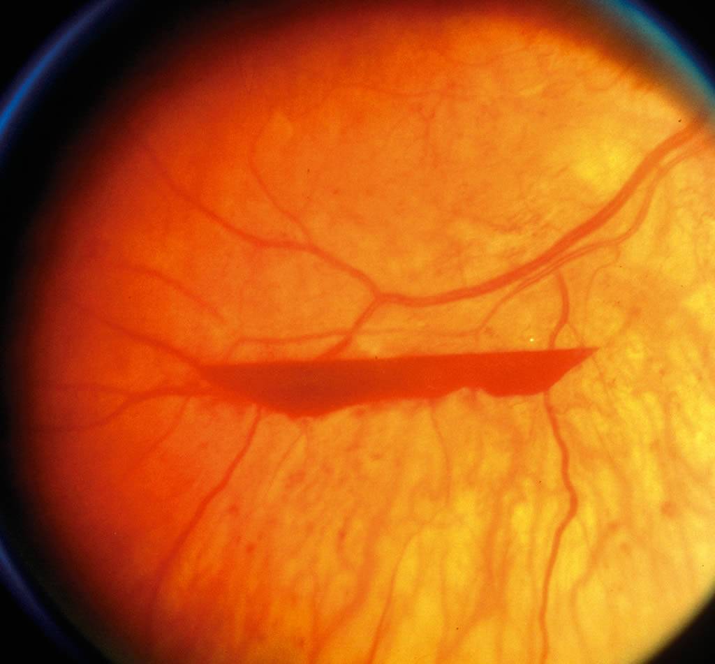 Из-за чего происходит разрыв сетчатки глаза? последствия, симптомы и лечение заболевания