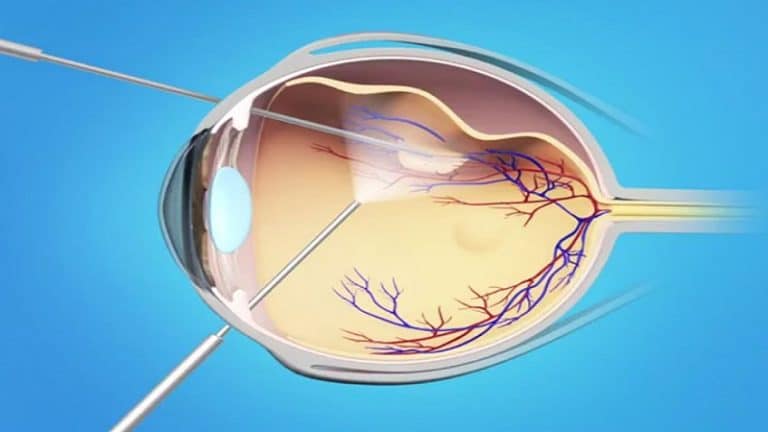Дистрофия сетчатки глаза: что это такое, опасно ли это, причины развития, факторы риска, лечение и профилактика