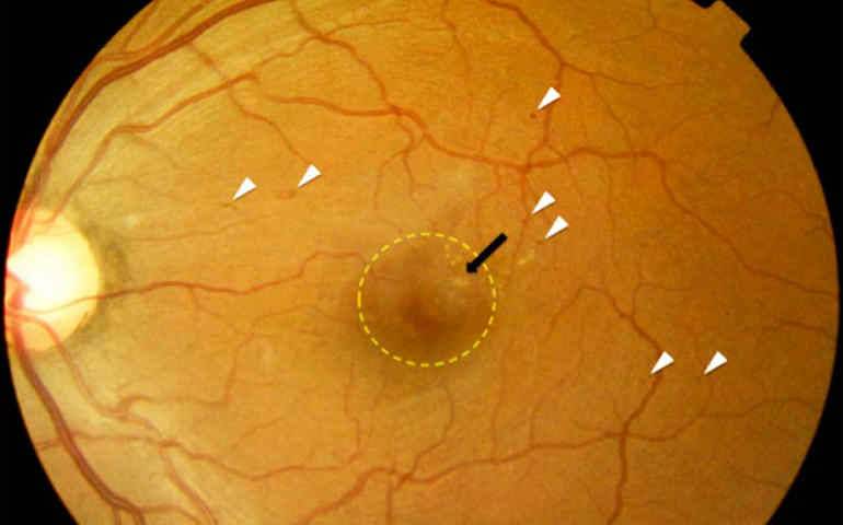 Успешное лечение влажной макулодистрофии сетчатки глаза с восстановлением зрения
