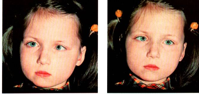Косоглазие у детей: причины и лечение, симптомы (фото), виды, страбизм до года