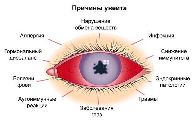 Увеит: симптомы, лечение, причины и диагностика глаз у взрослых