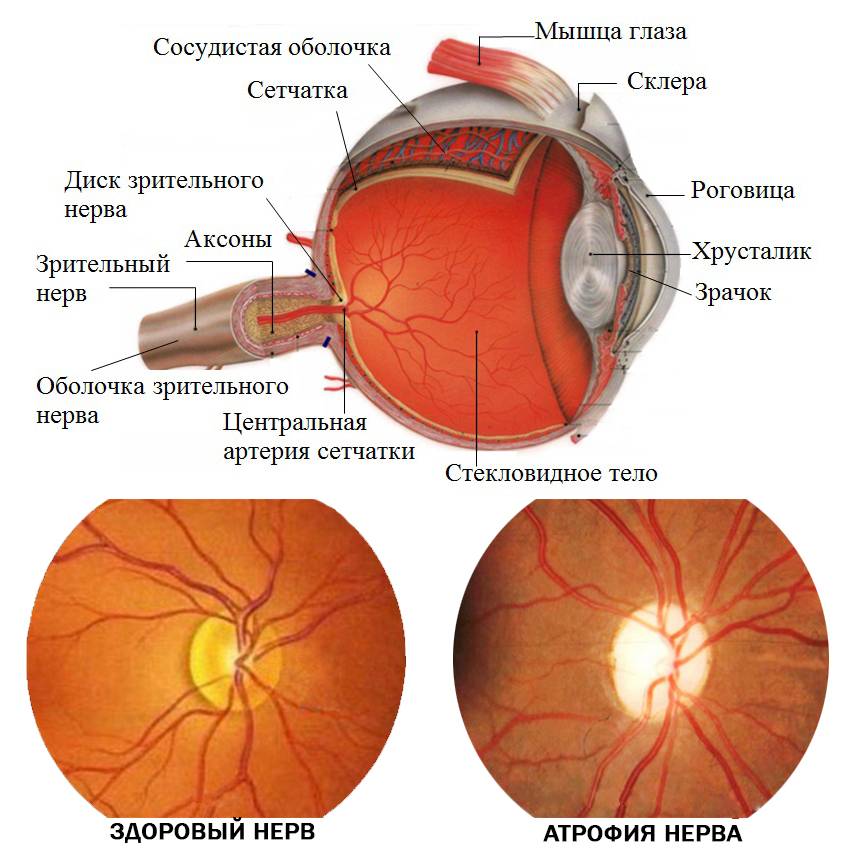 Атрофия зрительного нерва (полная и частичная): что это такое, симптомы, лечение