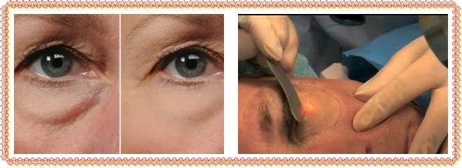 Удаление халязиона: показания и противопоказания - "здоровое око"