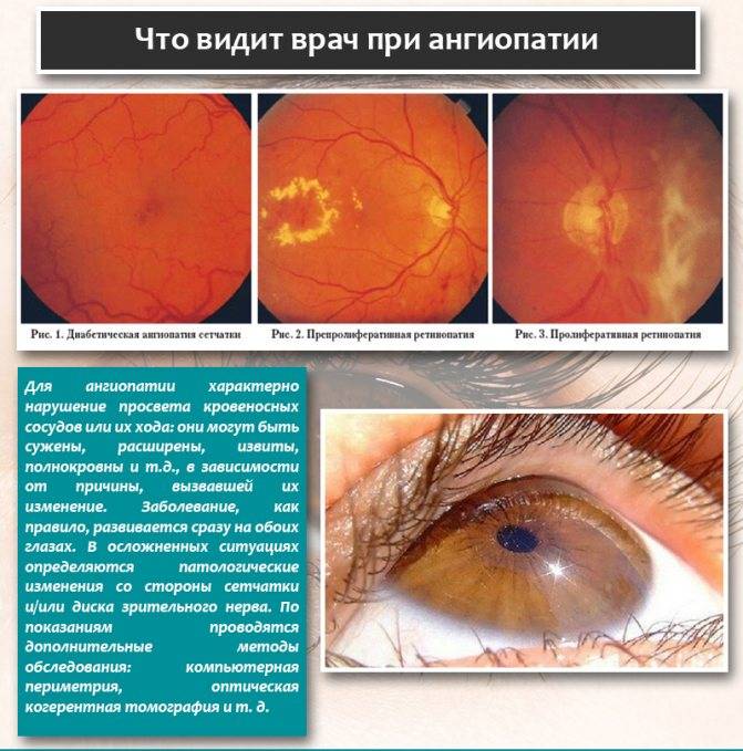 Ангиопатия сетчатки глаза у ребенка: причины заболевания, симптоматика, диагностика и лечение