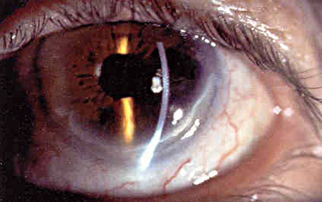 Артифакия глаза: что это такое, как лечить, показания и противопоказания, установка искусственного хрусталика, как проводят операцию, преимущества, осложнения