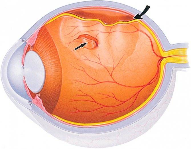 Задняя отслойка стекловидного тела (зост) - "здоровое око"
