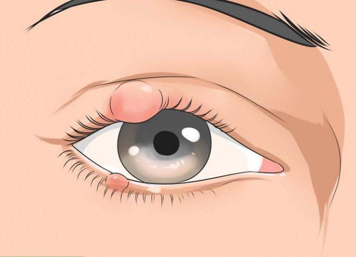Ячмень на глазу: причины появления и лечение