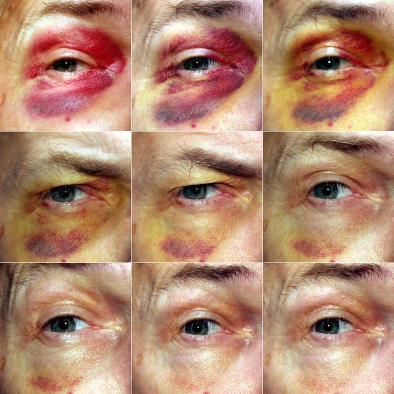 Сколько проходит синяк под глазом: стадии по дням до исчезновения и подход к лечению недуга