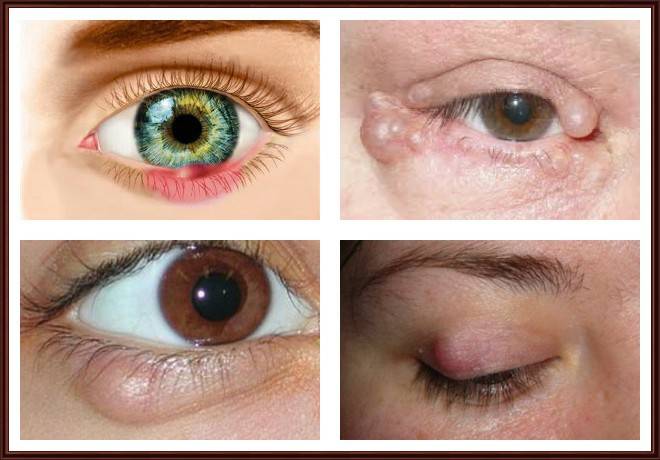 Рак глаза: симптомы, фото, причины, лечение и стадии