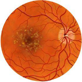 Дистрофия глаза : основные виды, причины, симптомы, лечение | компетентно о здоровье на ilive