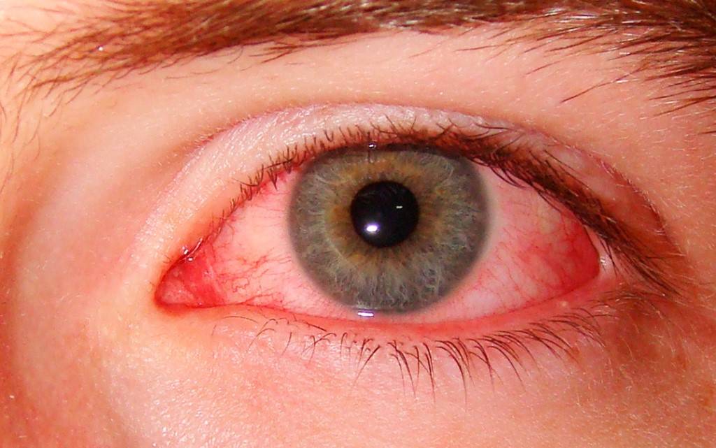 Красные глаза - причины, от чего краснеют глаза и что делать