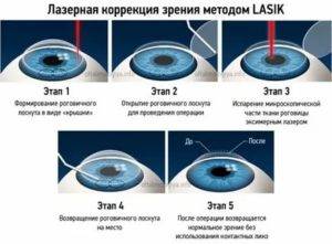 Можно ли делать лазерную коррекцию зрения