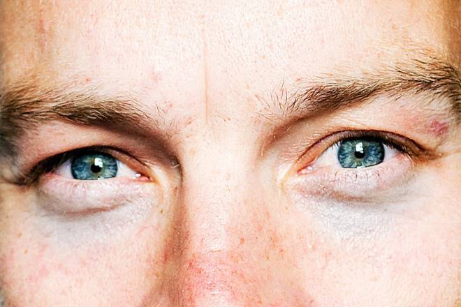 Круги, синяки и чернота под глазами у мужчин: причины